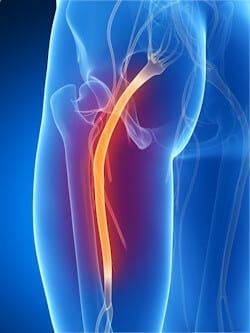 Sciatica Diagram