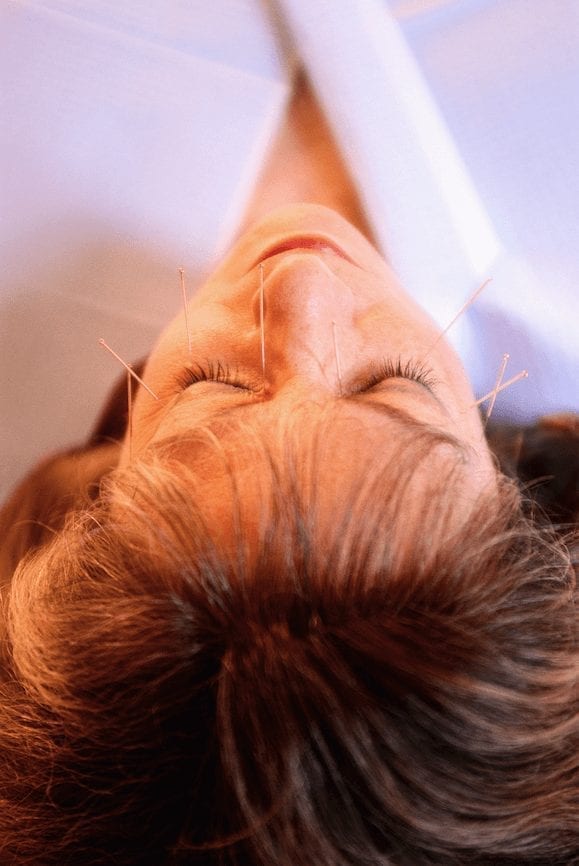 Facial Acupuncture: Natural Age-Defying