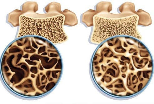 TCM Treatments for Osteoporosis