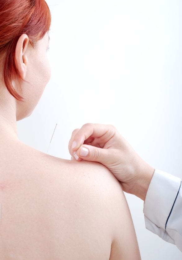 The Top Reasons People Don't Get Acupuncture (and Why They Should)