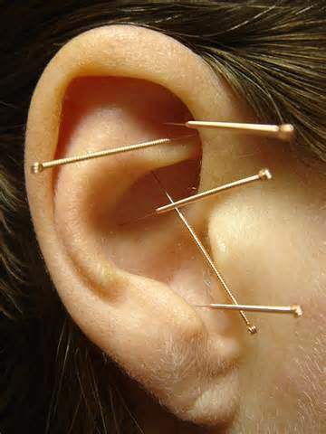 Auricular Acupuncture For Addictive Behavior