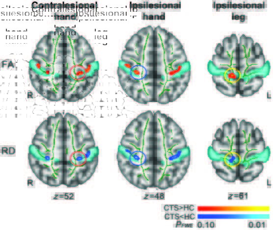 Acupuncture Shown to Rewire the Brain in New Carpal Tunnel Study