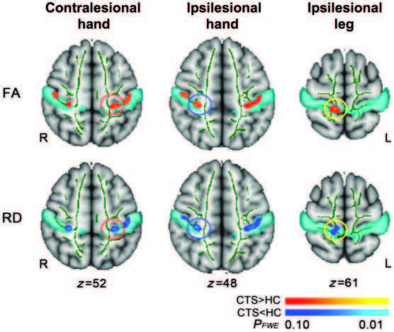 Acupuncture Shown to Rewire the Brain in New Carpal Tunnel Study