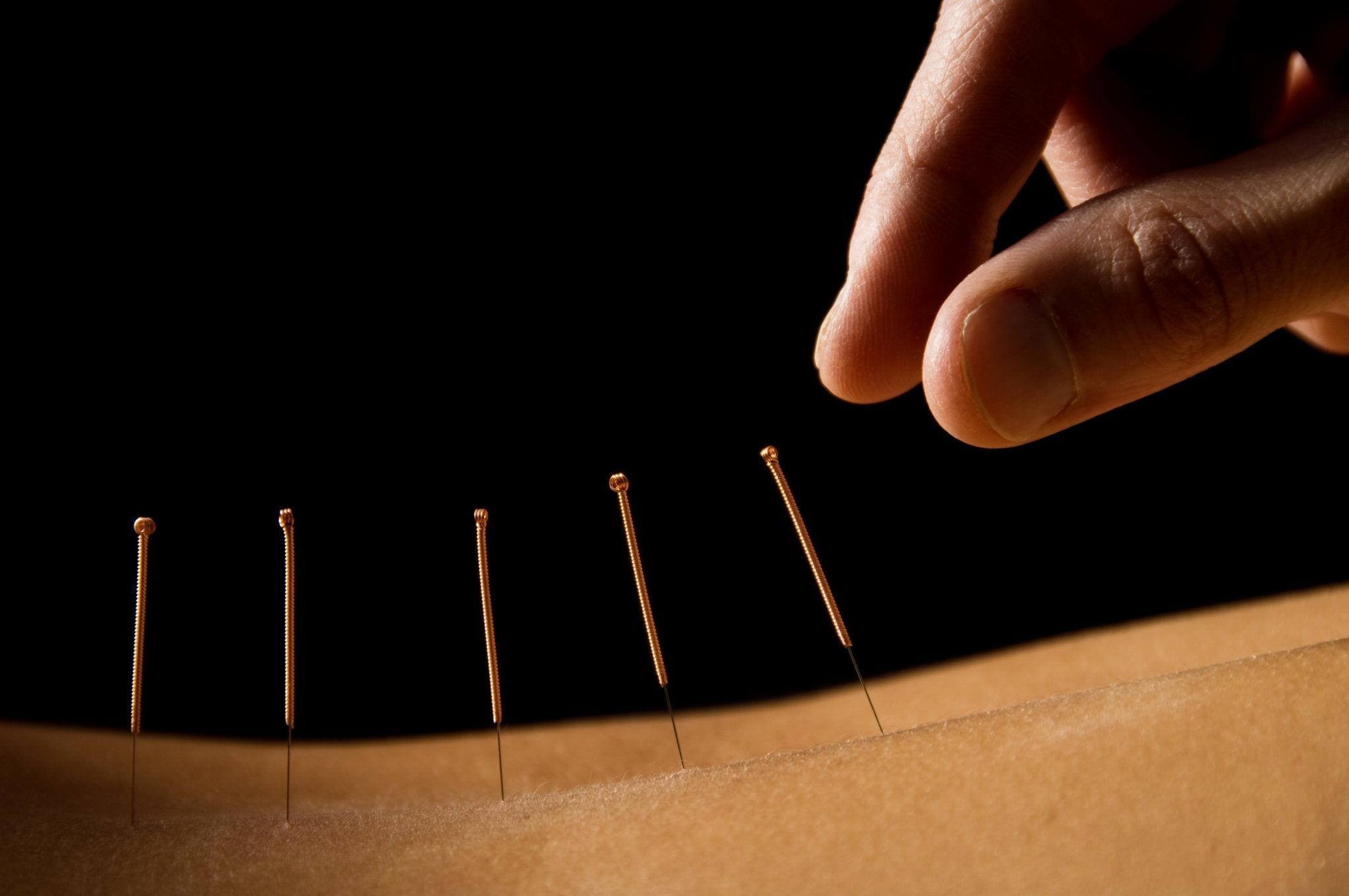 The Science of Acupuncture Safety: Risks, Harms, and Ancient Goodness