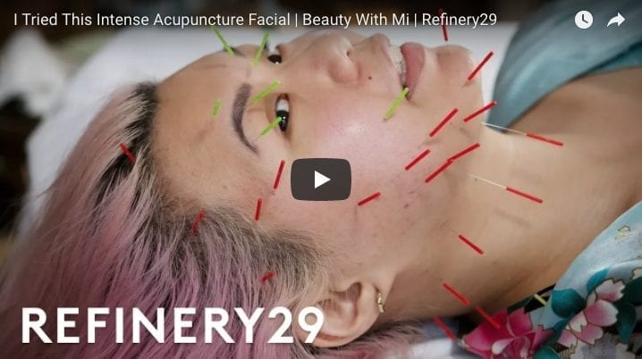 I Tried Facial Acupuncture & It Cleared My Acne