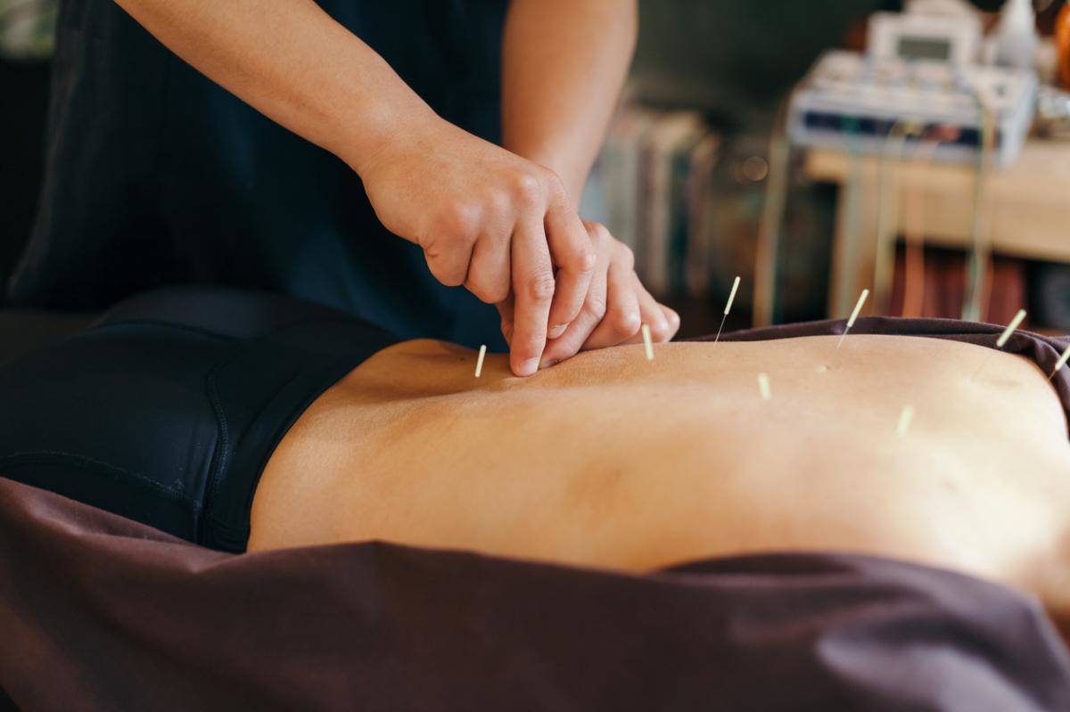 acupuncture as an alternative to opioids