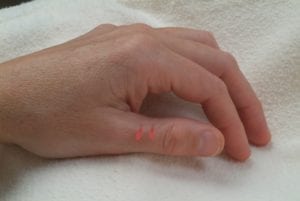 PHOTO: This two-point unit is located on the dorsal surface of the thumb, on the ulnar line of the proximal phalange, 0.3 cun lateral to the midline and halfway between the dorsal midline and the junction of red and white skin.