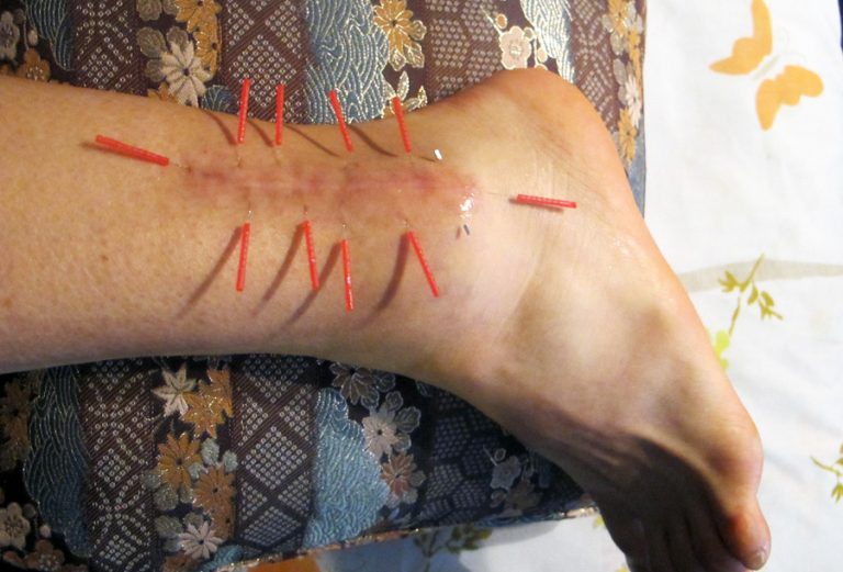 “The Body Remembers” Alleviating the LongTerm Impact of Injury with