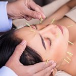 Woman getting acupuncture in her face.