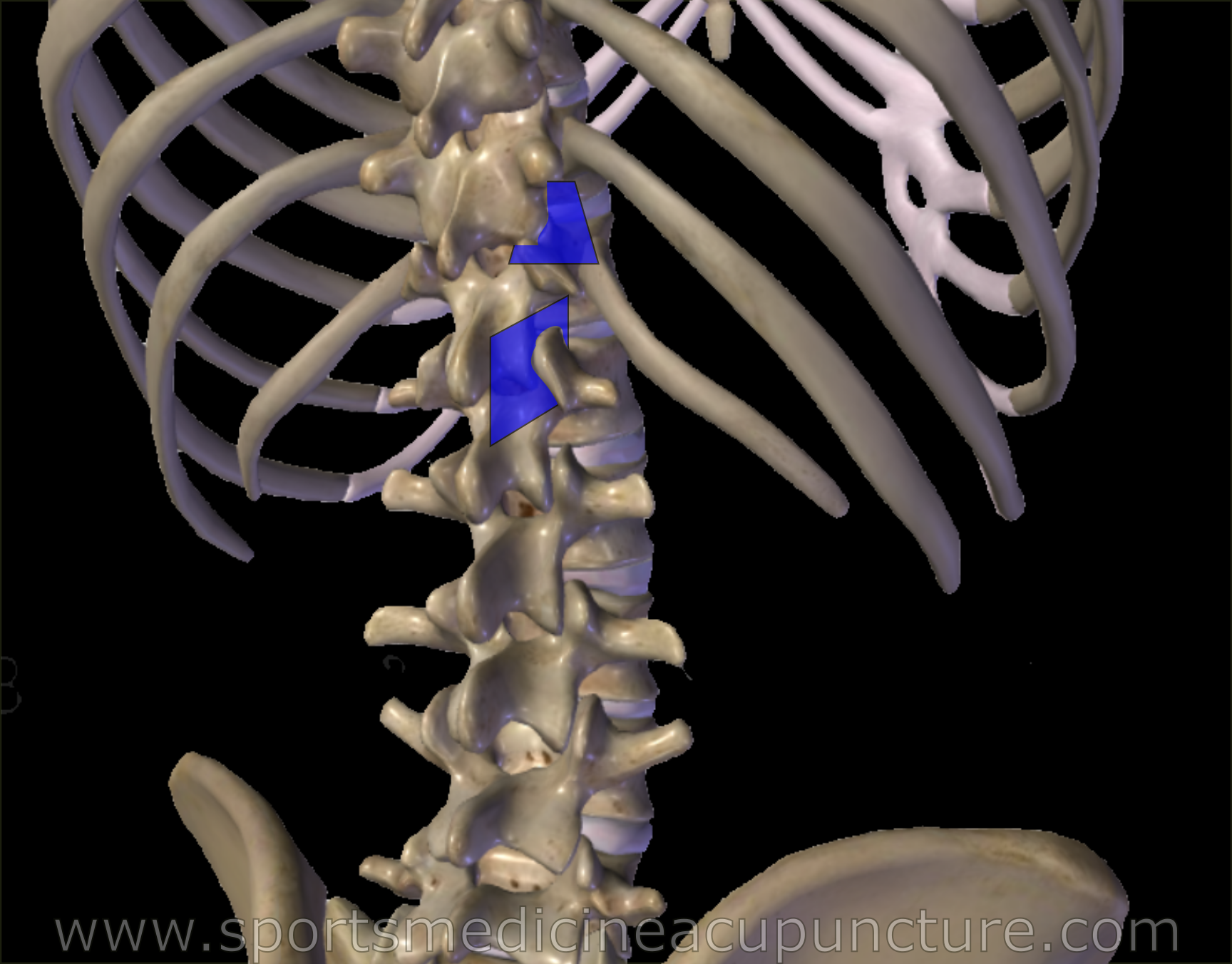 Pattern of left flank pain from the thoracolumbar junction syndrome.