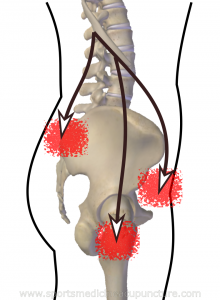Fig 4: Common pain referral seen in TLJS. Image skeleton generated by ZygoteBody Professional™.