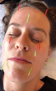 A person receiving cosmetic acupuncture treatment.